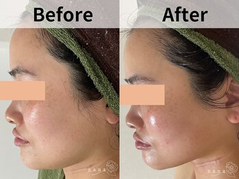 ナナ(nana)/ハーブピーリング|小顔矯正