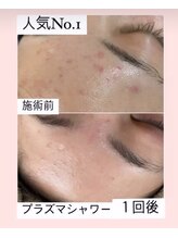 アールエム ボーテ(RM beaute')/プラズマフェイシャル