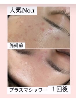 アールエム ボーテ(RM beaute')/プラズマフェイシャル