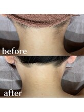 レヴール(reveur)/うなじ脱毛[美容脱毛/新潟脱毛]