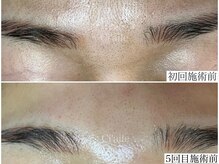 シエール 調布(Ci'aile)/本気の毛穴肌質改善