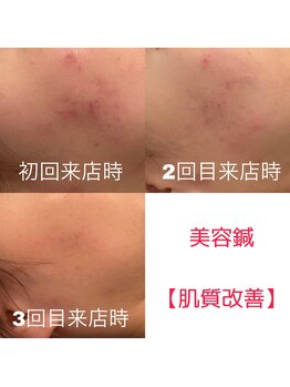 ベレディオ鍼灸整骨院(Belledio鍼灸整骨院)の写真/肌が変わる。印象が変わる。美容鍼で叶う“素肌美”の新習慣★ほうれい線やたるみ改善!リフトアップにも◎