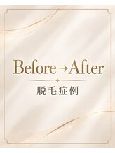 エクシアホワイトニング 岡崎店&nbsp;Before After