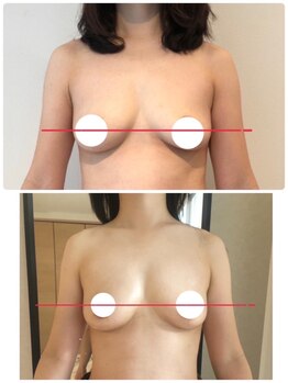美人バスト 渋谷店/【バストアップ☆育乳】症例