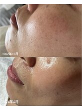 スパークル/毛穴/肌改善/ニキビケア/脱毛