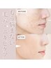 【毛穴・ニキビケア】肌のザラザラ＆毛穴の大掃除で肌質改善¥18,700→¥9,350
