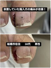 巻き爪じゅん 千葉駅前店/放置された陥入爪の痛みが改善