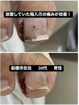 放置された陥入爪の痛みが改善