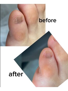 エム 平岸(M)/【副爪（1）】30代女性