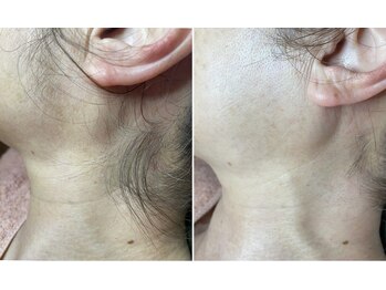 カミーシャ(KaMi-Sha)/もみ上げ＆うなじ脱毛