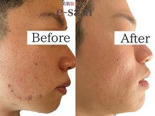 イーサム(e-sam)/光フェイシャル＆炭酸パック