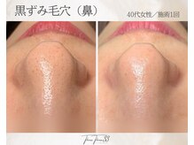スリースリー 恵比寿(THREE THREE)/毛穴角栓・毛穴黒ずみ・毛穴開き