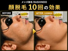 ラシンドウ 横浜鶴見店(RASHINDO)の雰囲気（【ヒゲ脱毛の効果】男性の剛毛に特化したハイパワー脱毛で激変）