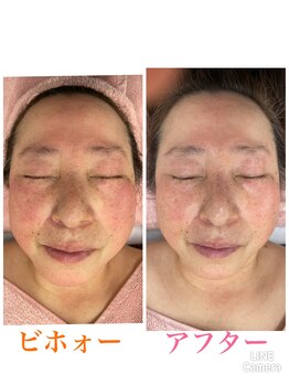 カレン(Current)/ファシア美リフト小顔コース