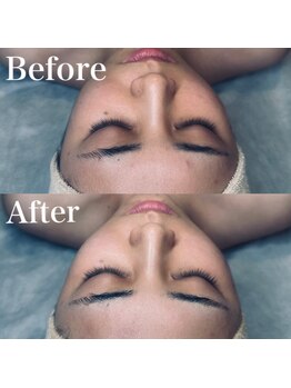 エクリア(ECLIA)/フェイシャル Before⇒After