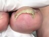 　【フットケア】トラブルケア1箇所×3回　16500円※1か月以内に再来の方限定