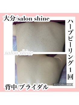 サロンシャイン(Salon Shine)/ハーブピーリング1回
