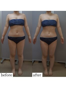 アップルミント/＜痩身＞before・after