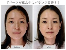 エピファニー(Epiphany)/30代　エラと顔の大きさ歪みが…