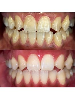 エール(aile)/うるま市セルフホワイトニング