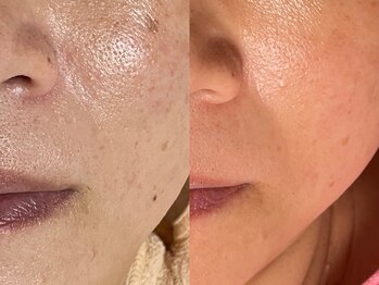 ゾーンビューティーハウス 柏店(ZONE BEAUTY HOUSE)/☆シミも毛穴もバイバイ☆