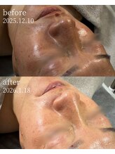 サロンナナジュウニ(Salon72)/くすみ/たるみ