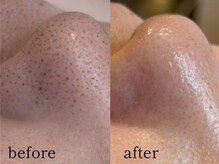 ウィズルーチェ 麻布十番店(with luce)/角質/角栓/メイク汚れ/皮脂