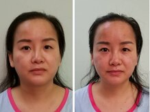 アゴラ/【小顔】【中国での実績もあり】