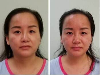 アゴラ/【小顔】【中国での実績もあり】