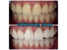 ホワイトニングショップ 天王寺店/40分照射×10回 20代女性