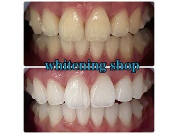 ホワイトニングショップ 天王寺店/40分照射×10回 20代女性