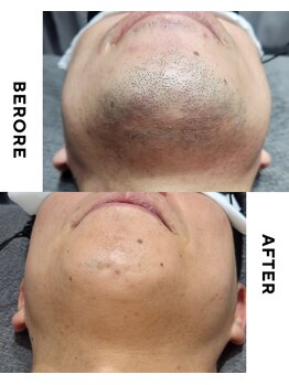 ユーフェム(U-fem)/ヒゲ脱毛24回目のお客様