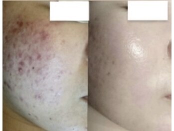 ムーンリズム(Moonlism)/【TIPハーブ症例】ニキビ/肌荒れ