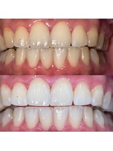 エール(aile)/うるま市セルフホワイトニング