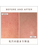 美時雨/毛穴にお悩みの方！
