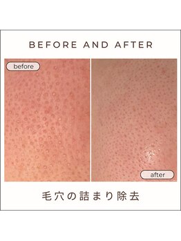 美時雨/毛穴にお悩みの方!