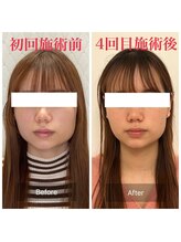カドル 新宿店(KADORU)/小顔矯正+美容機器 Before-After