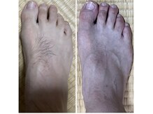 メンズ脱毛＆ヘッドスパ MEN'S with Lilina. 新横浜［ヒゲ脱毛/全身脱毛/VIO脱毛］/足脱毛　照射前後　メンズ脱毛