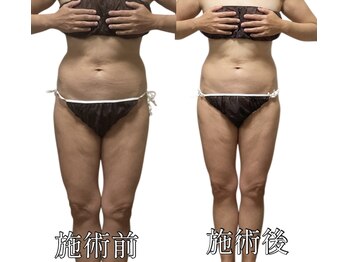 エリクシア 松戸/50代の方リンパケア２回目