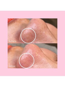 ホワイトラボ ライカム前店(White labo)/【施術例】毛穴洗浄ピーリング