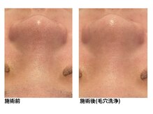 オーシャンブルー 長崎店(OCEAN BLUE)/毛穴の黒ずみケア（毛穴洗浄）