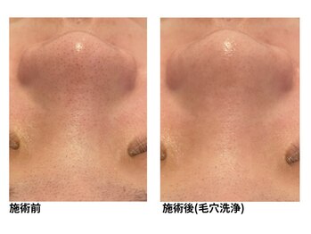 オーシャンブルー 長崎店(OCEAN BLUE)/毛穴の黒ずみケア(毛穴洗浄)