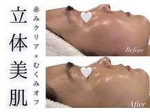 チッチ アフロディーテ(Chicchi Aphrodit)/毛穴洗浄＋ハーブピーリング