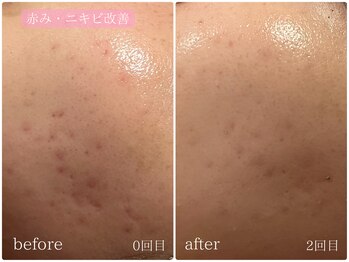 テン(10ten)/赤み・ニキビ改善