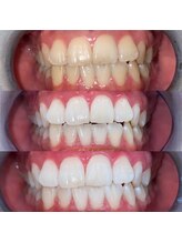 エール(aile)/沖縄市セルフホワイトニング