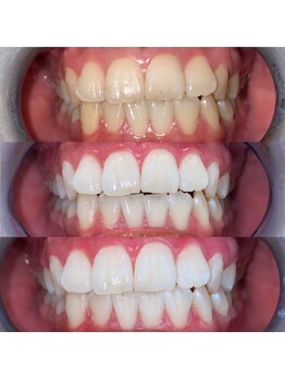 エール(aile)/沖縄市セルフホワイトニング