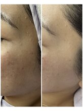 アイム テオ(I’mTHEO)/角質ケア