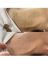 プライベートサロン プース(pousse)/首イボケア