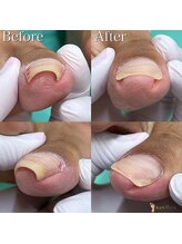巻き爪補正店　豊橋店【巻き爪・魚の目・角質・副爪】【5月上旬オープン（予定）】/巻き爪