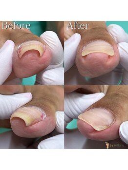 巻き爪補正店 豊橋店【巻き爪・魚の目・角質・副爪】【5月上旬オープン(予定)】/巻き爪